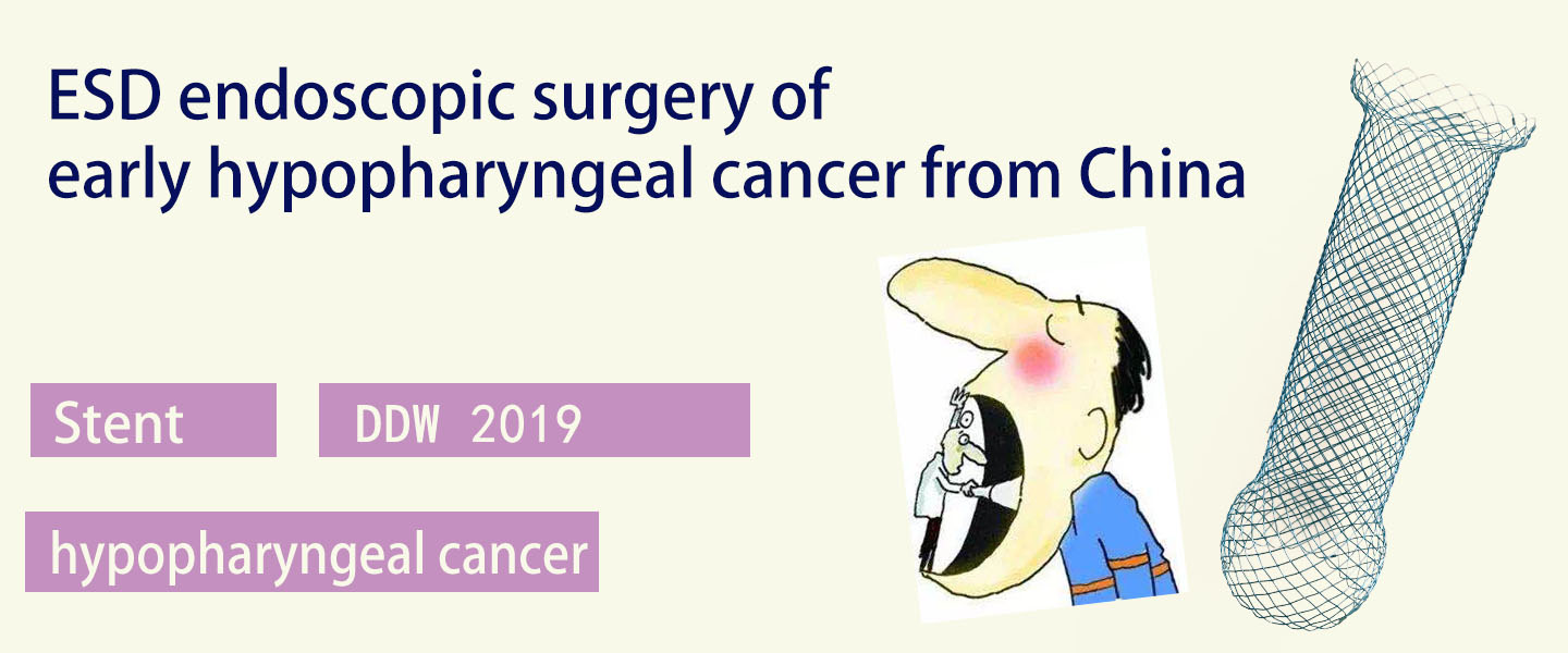 DDW 2019 Highlights ----ESD endoscopic surgery of early hypopharyngeal cancer from China
