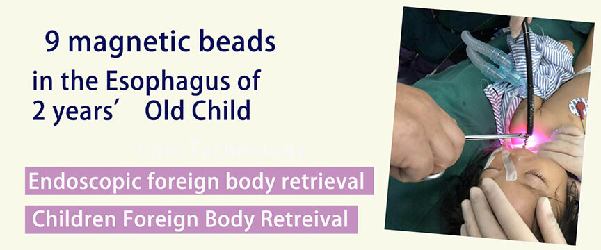 9 magnetic beads in the esophagus of 2 years old child